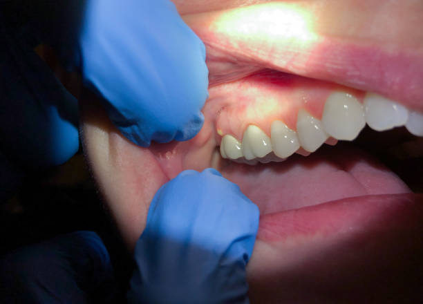 Best Emergency Tooth Extraction in Nixon, TX