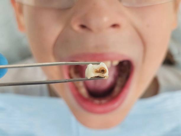 Best Emergency Treatment for Toothache in Nixon, TX